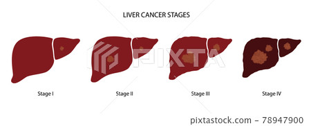 Liver disease concept 78947900