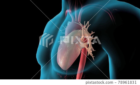 Abdominal aorta, Rupture of an abdominal aortic aneurysm Abdominal aorta, Rupture of an abdominal aortic aneurysm 78961831