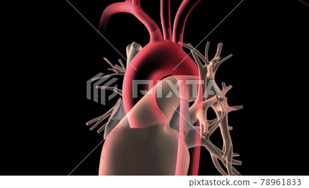 Abdominal aorta, Rupture of an abdominal aortic aneurysm 78961833