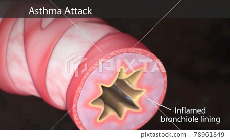 Asthma atack illustration Human lungs with bronchi of mesh of model. Looping motion animated 3d model. 78961849