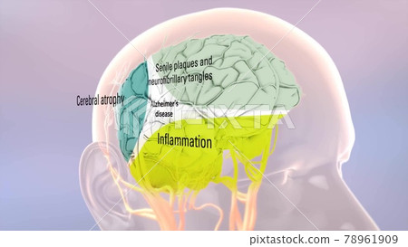 Human brain. Healthy and brain with Alzheimer's disease 78961909