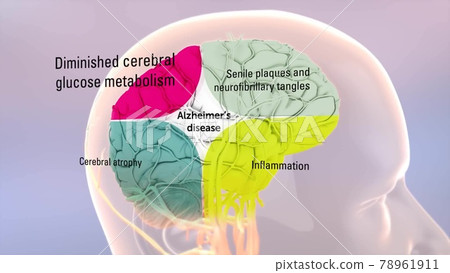 Human brain. Healthy and brain with Alzheimer's disease 78961911