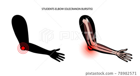 Student elbow bursitis Student elbow bursitis 78982571