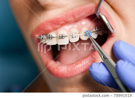 Dentist placing braces on female patient teeth. 78991019