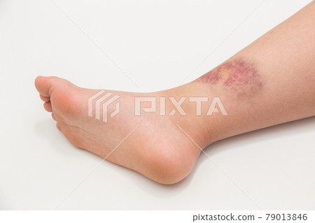 Elementary school student's foot bruise 79013846