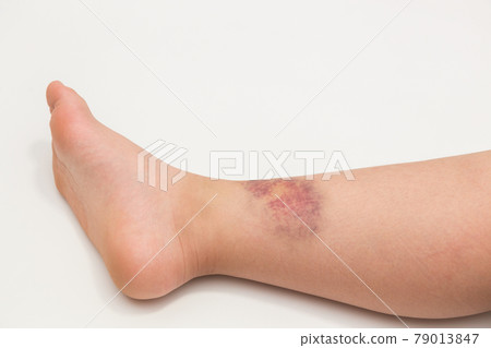 Elementary school student's foot bruise 79013847