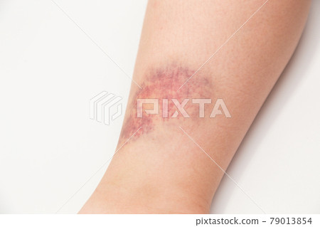 Elementary school student's foot bruise Elementary school student's foot bruise 79013854