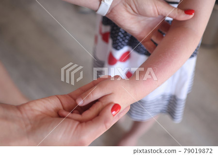 Sunburn redness and peeling of skin on child hand closeup Sunburn redness and peeling of skin on child hand closeup 79019872