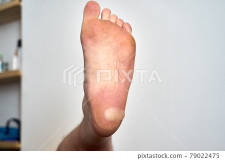 A large blister on the heel of a foot 79022475