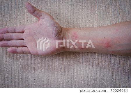 毛蟲皮炎 79024984