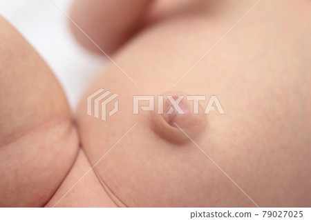 Baby navel with umbilical hernia Baby navel with umbilical hernia 79027025