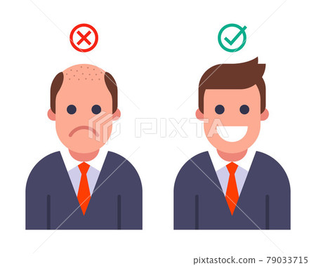 bald man transplanted hair. result before and after hair transplant. 79033715