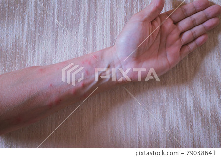 Caterpillar dermatitis 79038641