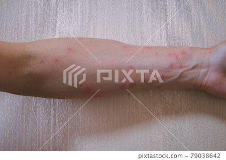 Caterpillar dermatitis Caterpillar dermatitis 79038642