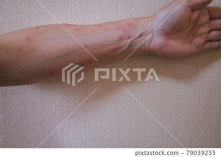 毛蟲皮炎 79039255