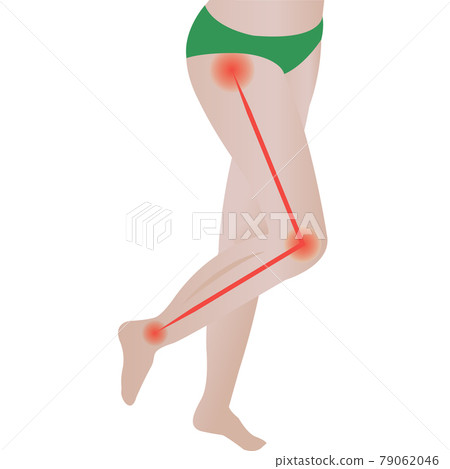 Joint pain. Sciatic Nerve. sciatic back pain. vector illustration 79062046