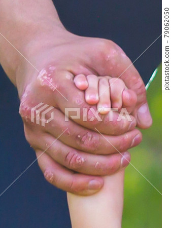 Man's hand with skin disease holds daughter's baby hand Man's hand with skin disease holds daughter's baby hand 79062050