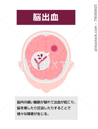 腦出血的原因和症狀插圖矢量圖（附評論） 79080605