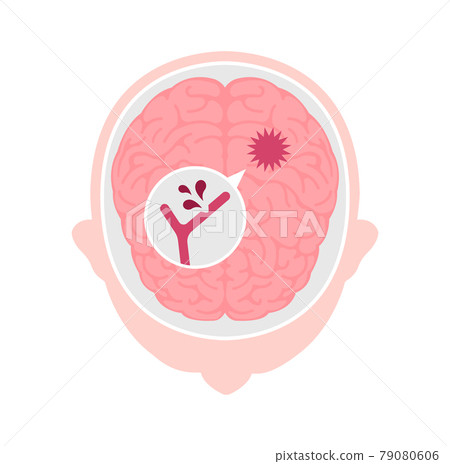 腦出血的原因和症狀插圖矢量圖（無字母） 79080606