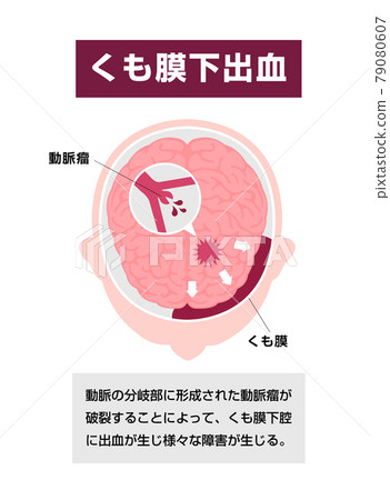 蛛網膜下腔出血的原因和症狀插圖矢量圖（附評論） 79080607