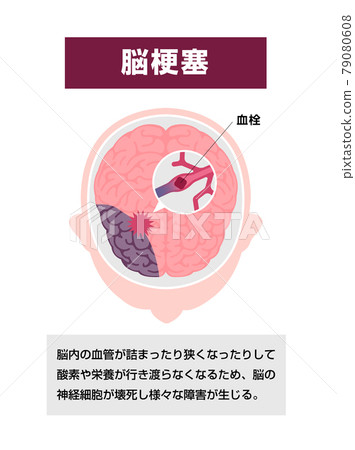 腦梗塞的原因和症狀插圖矢量圖（附評論） 79080608