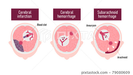 中風的原因和症狀（腦梗塞、腦出血、蛛網膜下腔出血）插圖矢量圖（英文） 79080609
