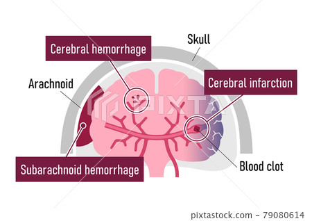 中風的原因和症狀（腦梗塞、腦出血、蛛網膜下腔出血）插圖矢量圖（英文） 79080614