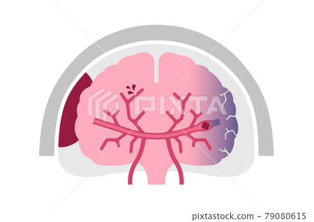 Causes and symptoms of stroke (cerebral infarction, cerebral hemorrhage, subarachnoid hemorrhage) Illustrated vector illustration (no text) Causes and symptoms of stroke (cerebral infarction, cerebral hemorrhage, subarachnoid hemorrhage) Illustrated vector illustration (no text) 79080615
