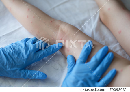 Doctor dermatologist in rubber gloves examining rash on skin of child feet closeup 79098681