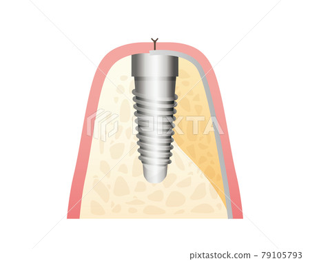 種植體治療圖(牙齒/牙齦) 種植體治療圖(牙齒/牙齦) 79105793