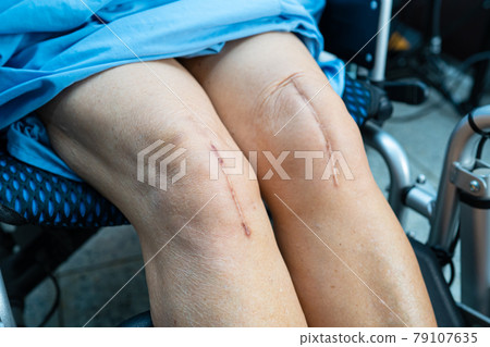 Asian senior or elderly old lady woman patient show her scars surgical total knee joint replacement Suture wound surgery arthroplasty on bed in nursing hospital ward, healthy strong medical concept. 79107635