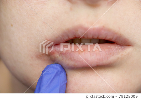 Herpes on the lips: a woman with a cold and the herpes virus is examined by a dermatologist and infectious disease specialist Herpes on the lips: a woman with a cold and the herpes virus is examined by a dermatologist and infectious disease specialist 79128009