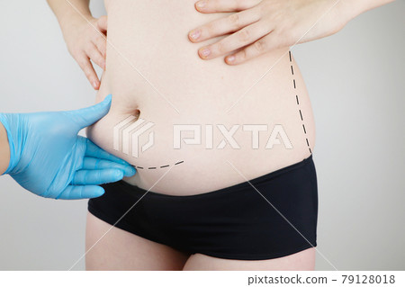 Abdominoplasty and torsoplasty: abdominal liposuction and removal of the apron. The patient at the reception at the plastic surgeon 79128018
