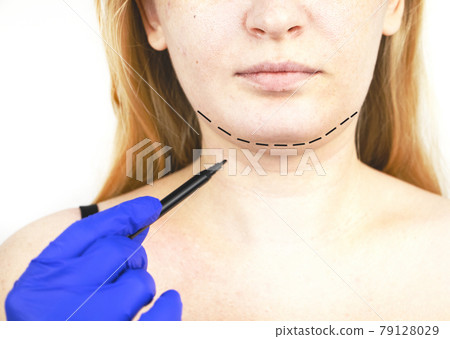 Mentoplasty: plastic chin. Patient before chin and neck surgery. Plastic surgeon advises 79128029
