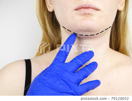 Mentoplasty: plastic chin. Patient before chin and neck surgery. Plastic surgeon advises Mentoplasty: plastic chin. Patient before chin and neck surgery. Plastic surgeon advises 79128032