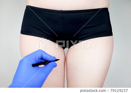 Plastic surgery: femoroplasty, cruroplasty, buttocks endoprosthetics, gluteoplasty. Patient on consultation with a plastic surgeon Plastic surgery: femoroplasty, cruroplasty, buttocks endoprosthetics, gluteoplasty. Patient on consultation with a plastic surgeon 79129237