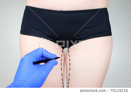 Plastic surgery: femoroplasty, cruroplasty, buttocks endoprosthetics, gluteoplasty. Patient on consultation with a plastic surgeon Plastic surgery: femoroplasty, cruroplasty, buttocks endoprosthetics, gluteoplasty. Patient on consultation with a plastic surgeon 79129238