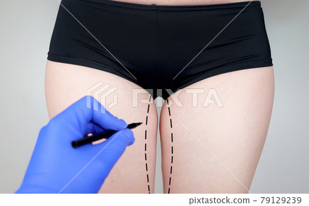Plastic surgery: femoroplasty, cruroplasty, buttocks endoprosthetics, gluteoplasty. Patient on consultation with a plastic surgeon Plastic surgery: femoroplasty, cruroplasty, buttocks endoprosthetics, gluteoplasty. Patient on consultation with a plastic surgeon 79129239