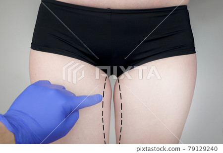 Plastic surgery: femoroplasty, cruroplasty, buttocks endoprosthetics, gluteoplasty. Patient on consultation with a plastic surgeon Plastic surgery: femoroplasty, cruroplasty, buttocks endoprosthetics, gluteoplasty. Patient on consultation with a plastic surgeon 79129240