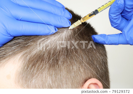 Hair mesotherapy or hair transplant: a beautician doctor makes injections in the man head for hair growth or to prevent baldness Hair mesotherapy or hair transplant: a beautician doctor makes injections in the man head for hair growth or to prevent baldness 79129372