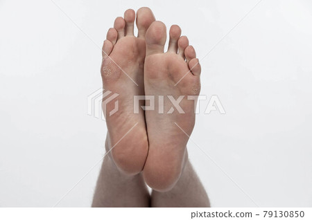 Underside of caucasian young man's naked bare tired feet with dry, flaking skin, isolated on white 79130850