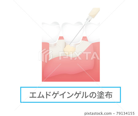 Illustration of dental treatment (Emdgain gel) Illustration of dental treatment (Emdgain gel) 79134155