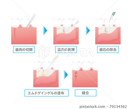 Illustration of dental treatment (Emdgain gel) 79134362