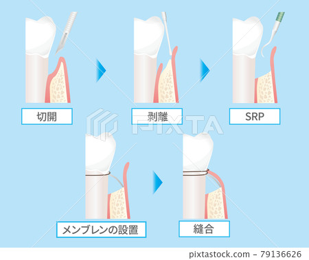 Membrane treatment illustration (teeth / gums) Membrane treatment illustration (teeth / gums) 79136626