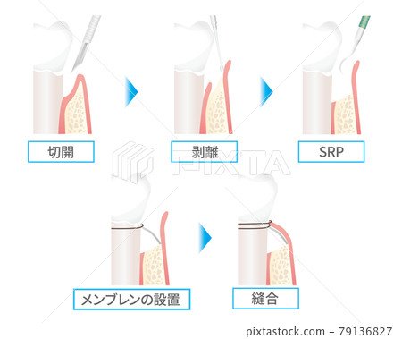 膜處理插圖（牙齒/牙齦） 79136827