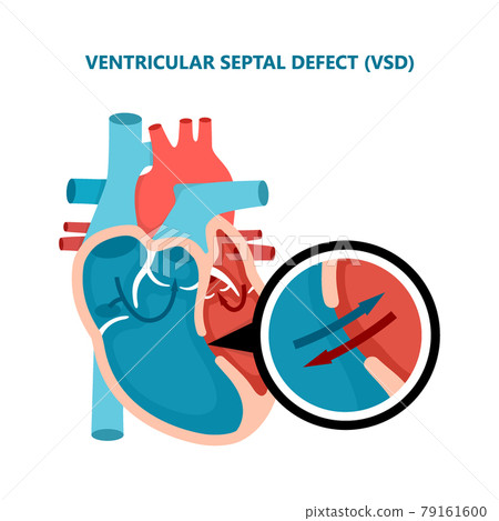 Ventricular septal defect VSD. Human heart muscle diseases cross-section. Cardiology concept. Ventricular septal defect VSD. Human heart muscle diseases cross-section. Cardiology concept. 79161600