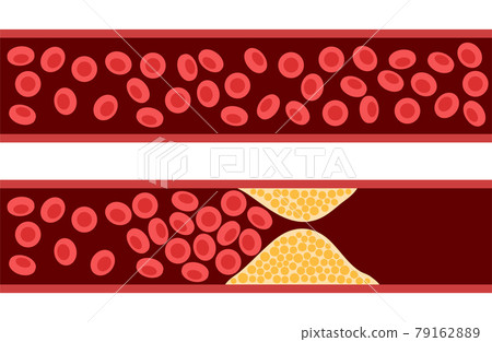 Cholesterol and atherosclerosis 79162889