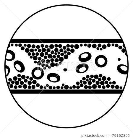 Cholesterol and atherosclerosis Cholesterol and atherosclerosis 79162895