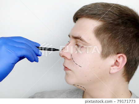 A man at the reception at the plastic surgeon. Before nose surgery, rhinoplasty A man at the reception at the plastic surgeon. Before nose surgery, rhinoplasty 79171773