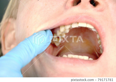 The hole in the tooth and the treatment of dental canals. Treatment of periodontitis in the dental clinic 79171781